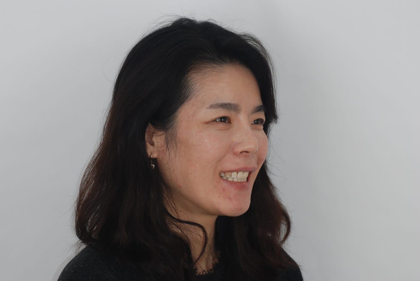 原本不整齊的前牙經矯正後變得整齊之案例 — 治療後