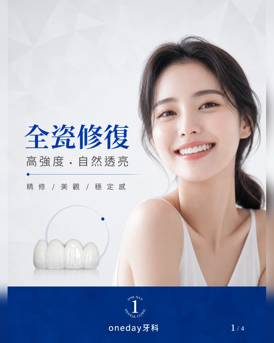全瓷冠 全瓷修復 自然透光