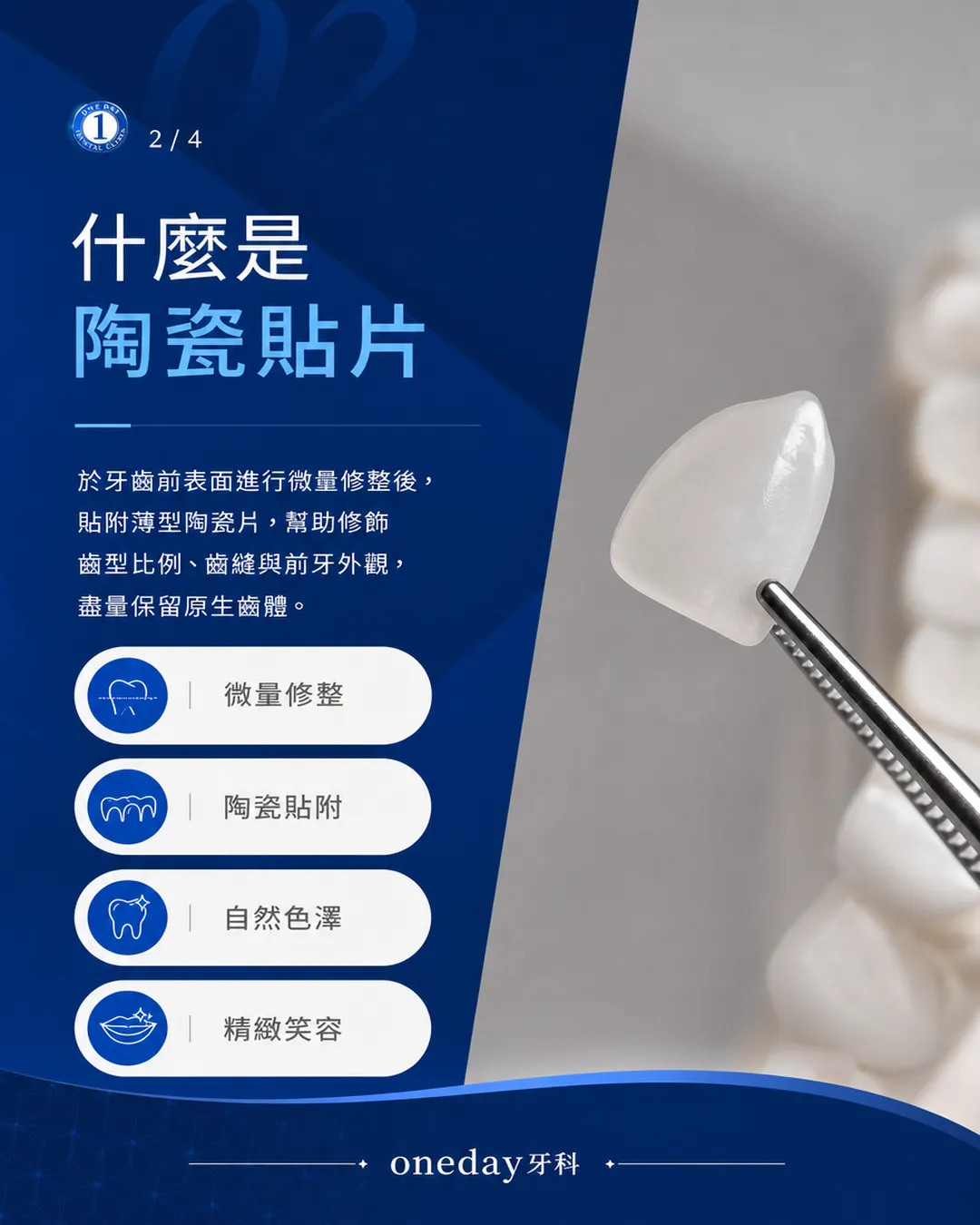 陶瓷貼片 數位微笑設計 自然齒形